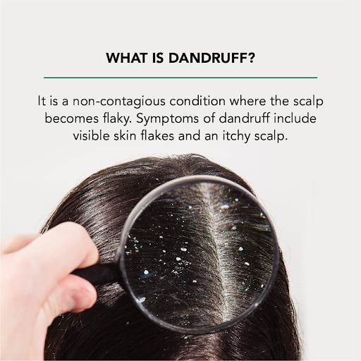 Natural Dandruff Solutions: Essential Oils and Herbs for Healthy Hair